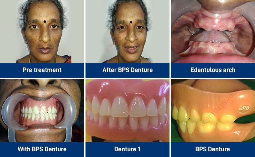 BPS, Flexible dentures & Obturators