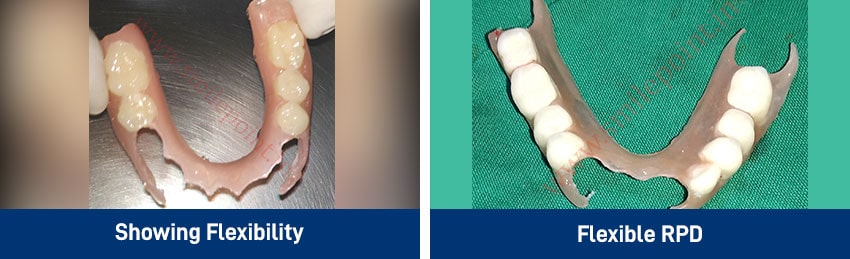 BPS, Flexible dentures & Obturators