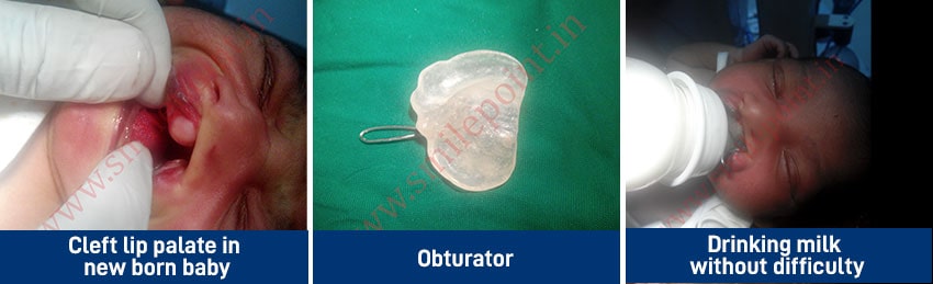 BPS, Flexible dentures & Obturators