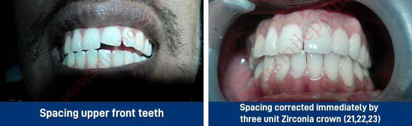 Ceramic and zirconia based fixed teeth