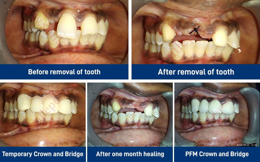 Ceramic and zirconia based fixed teeth