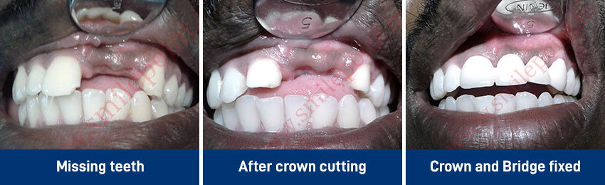 Ceramic and zirconia based fixed teeth