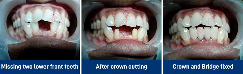 Ceramic and zirconia based fixed teeth