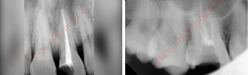 Computer assisted and navigated root canal treatment