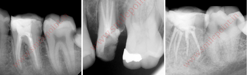 Computer assisted and navigated root canal treatment