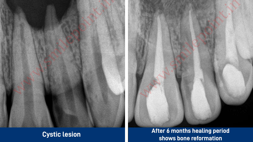 Computer assisted and navigated root canal treatment