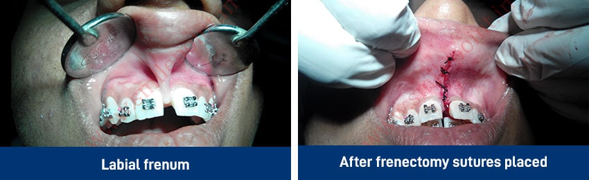 Minor oral surgery - wisdom tooth removal, tongue tie removal, etc.