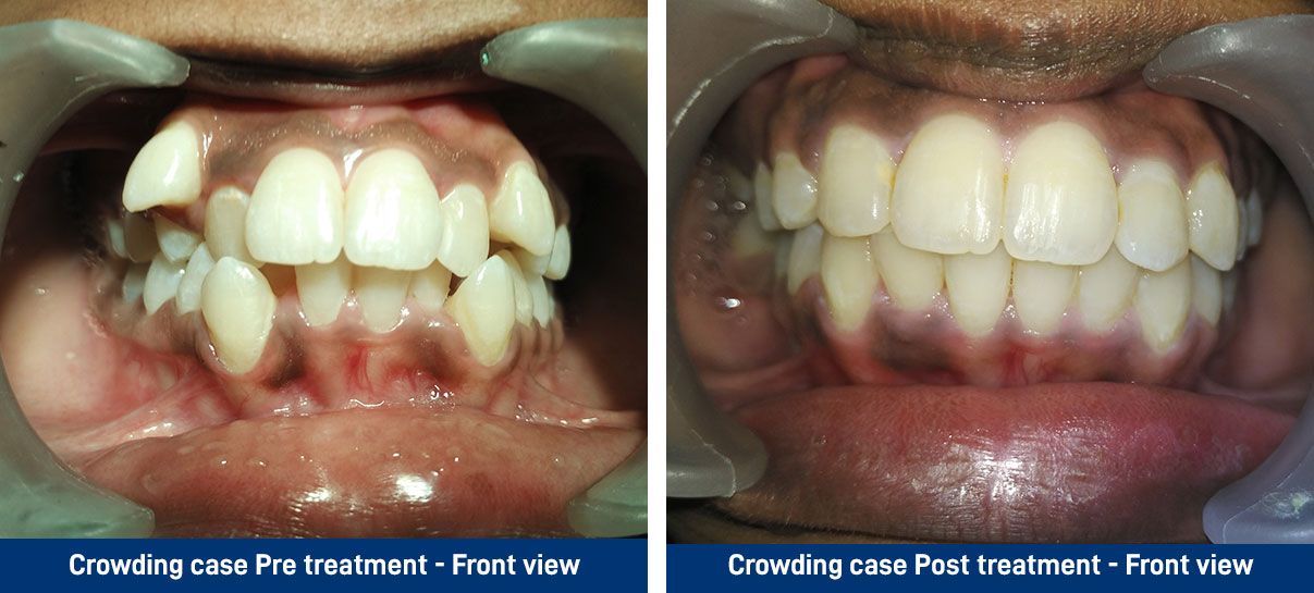 Crowding case Pre treatment