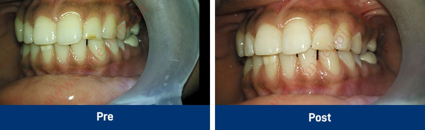 Tooth Coloured Fillings