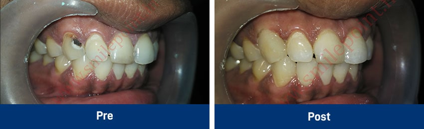 Tooth Coloured Fillings