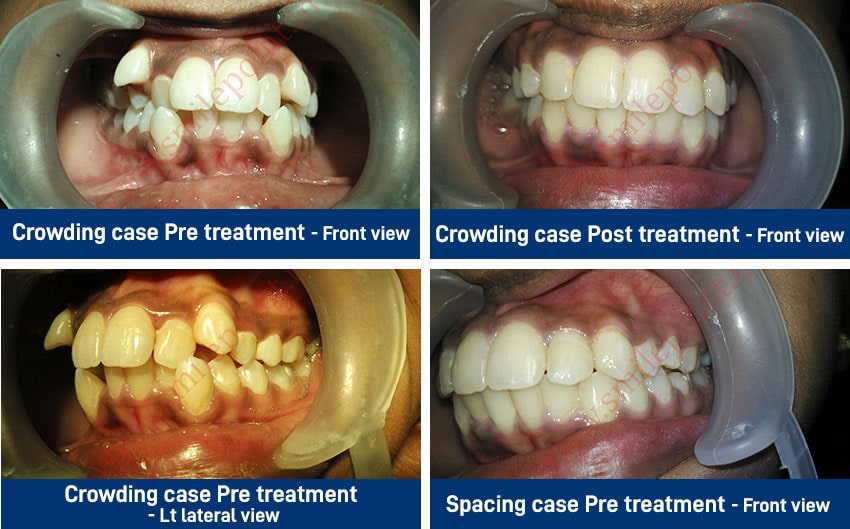 Tooth coloured and metal clips for teeth alignment