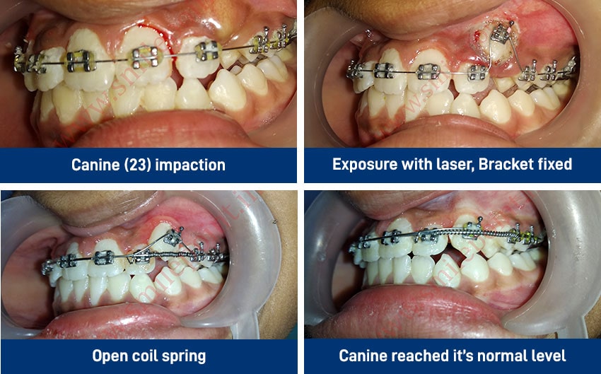 Tooth coloured and metal clips for teeth alignment