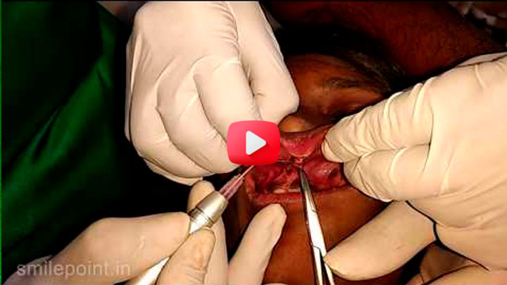 Laser treatment - Labial frenectomy